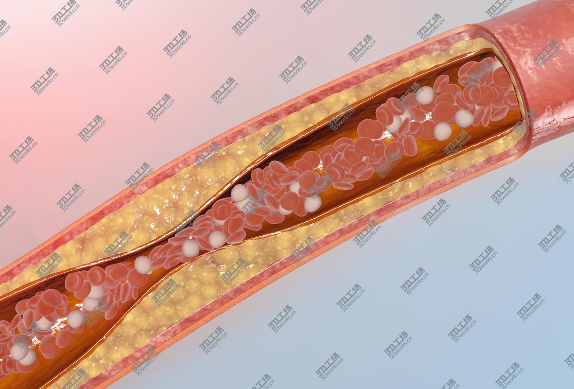 images/goods_img/2021040232/blocked blood vessel animation 3D model/1.jpg